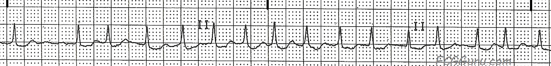 Ecg Basics Atrial Fibrillation With A Rapid Ventricular Response Ecg